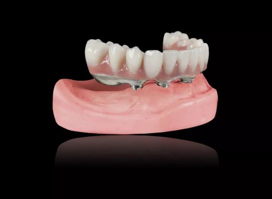 주문 임플란트 티타늄 바 제거 가능한 치아 치아 티타늄 합금 임플란트 바 과장 치아 online manufacture