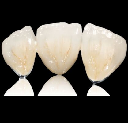 주문 맞춤형 반 귀한 왕관 또는 다리 귀한 합금 왕관 및 다리 online manufacture